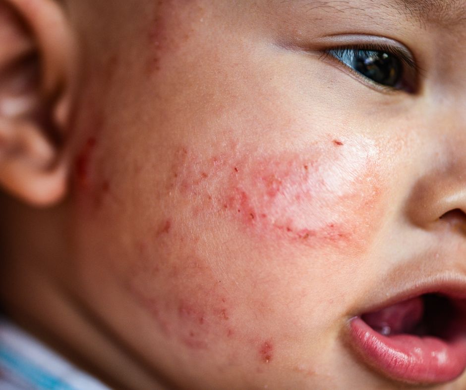 Ako lie&ccaron;i&tcaron; l&eacute;zie &ndash; 10 tipov