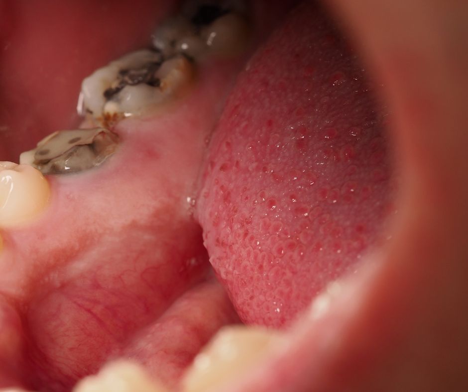 Ako vyzer&aacute; zubn&yacute; kaz?