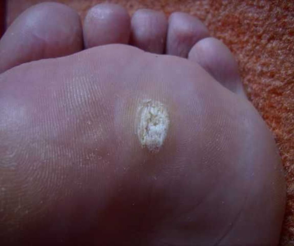 Bradavica na chodidle: Pr&iacute;&ccaron;iny, lie&ccaron;ba a prevencia