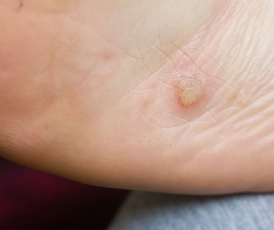 Dyshidrotický ekzém: Príznaky, príčiny a liečba