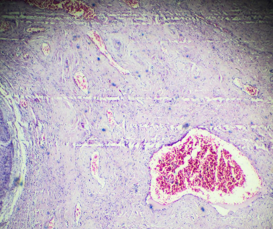 Dysplázia krčka maternice: Príčiny, symptómy a liečba