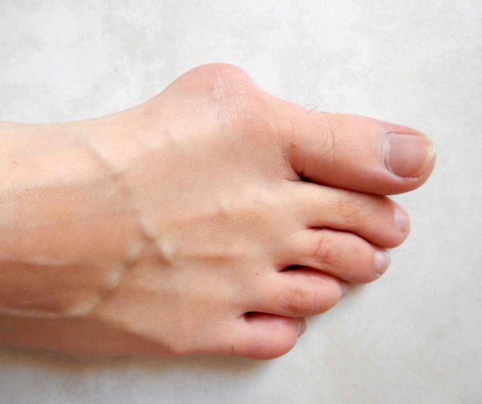 Haluxy na noh&aacute;ch &ndash; Pr&iacute;&ccaron;iny, sympt&oacute;my a lie&ccaron;ba