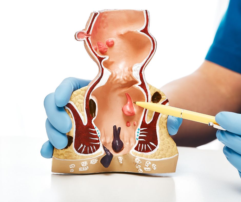 Krv&aacute;canie z kone&ccaron;n&iacute;ka: pr&iacute;&ccaron;iny a mo&zcaron;nosti lie&ccaron;by