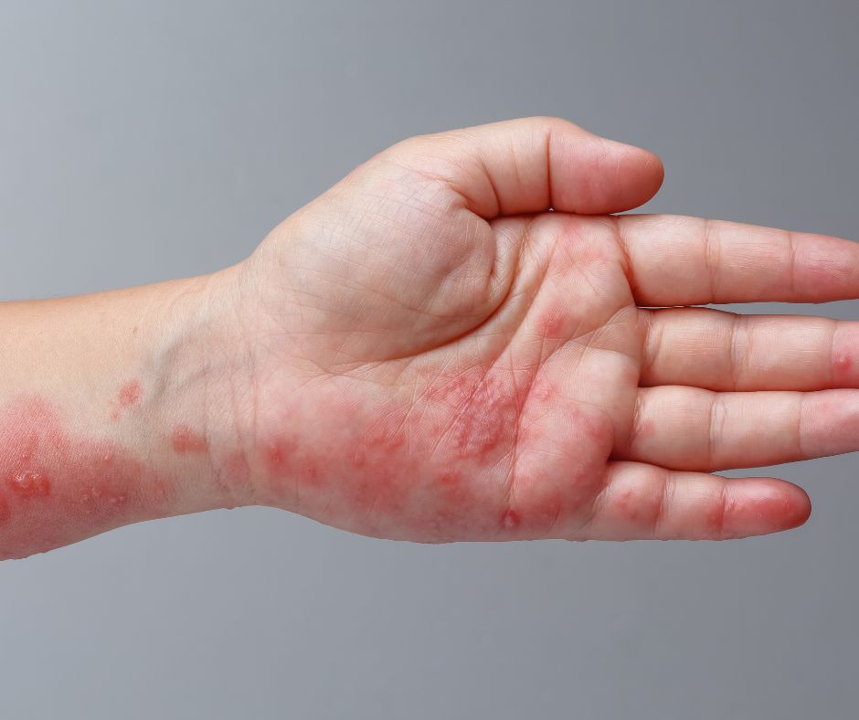 P&aacute;sov&yacute; opar: Pr&iacute;znaky, lie&ccaron;ba a prevencia