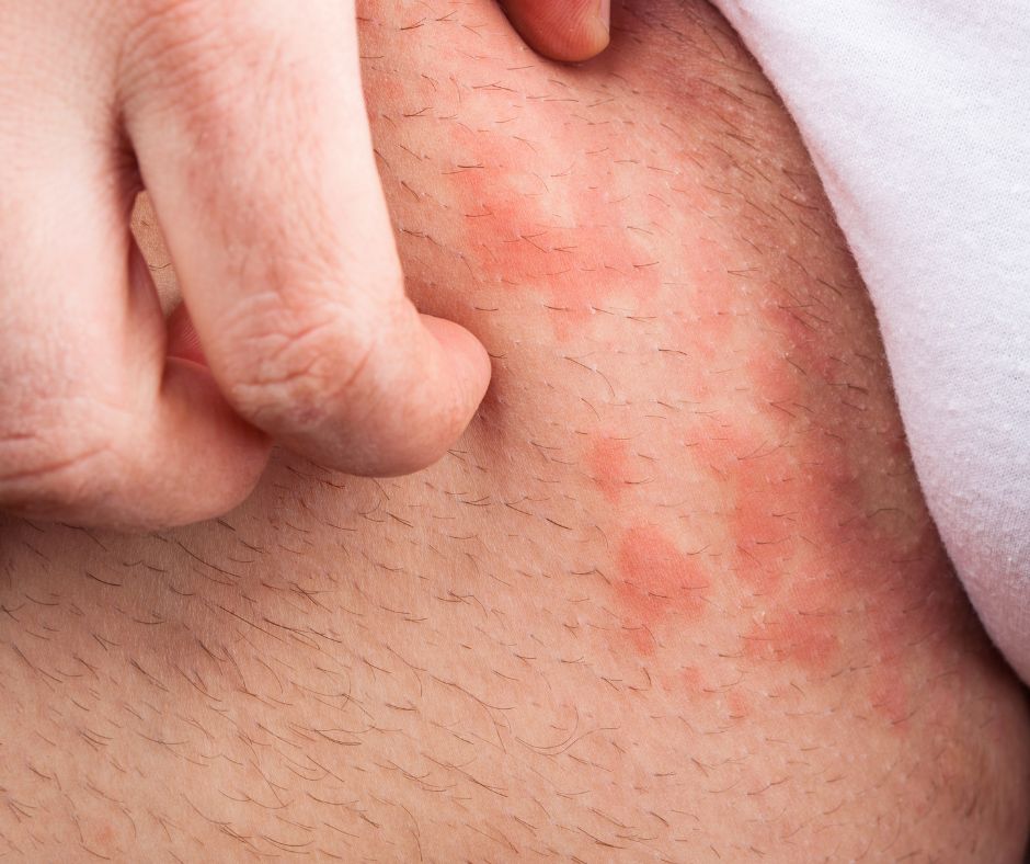 Alergie hraju vyznamnu ulohu pri vzniku zihlavky a to najma pri akutnej forme