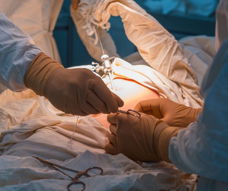 Chirurgicka liecba je casto odporucana v pripade vacsich a symptomatickych pruhov u deti