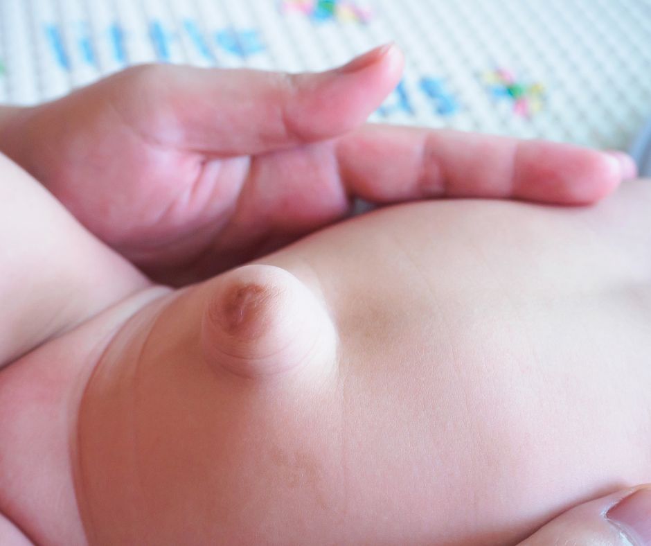 Hernia umbilicalis je dalsim beznym typom pruhu u deti Vyskytuje sa v oblasti pupka kde vnutorne organy prechadzaju cez slabu miestnost vo svalovej stene brusnej dutiny