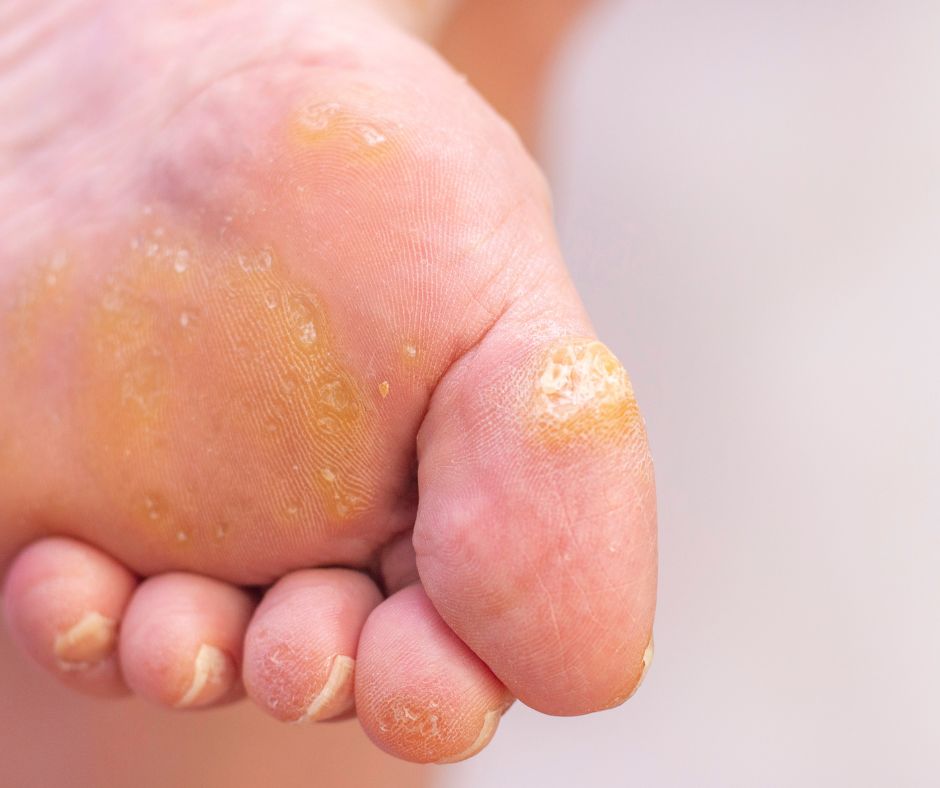 Kurie oko je zhrubnutie pokozky ktore je viditelne ako hrbolata hruba a tvrda oblast