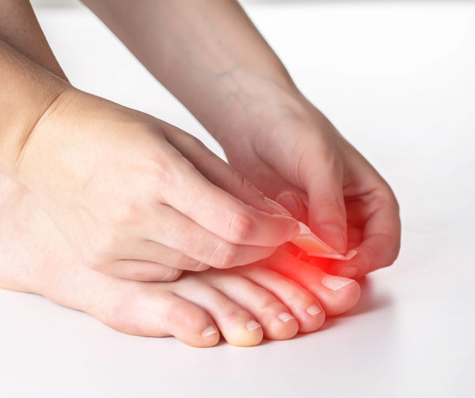 Obvaz alebo obvazova naplast mozu chranit kurie oko pred trenim a tlakom