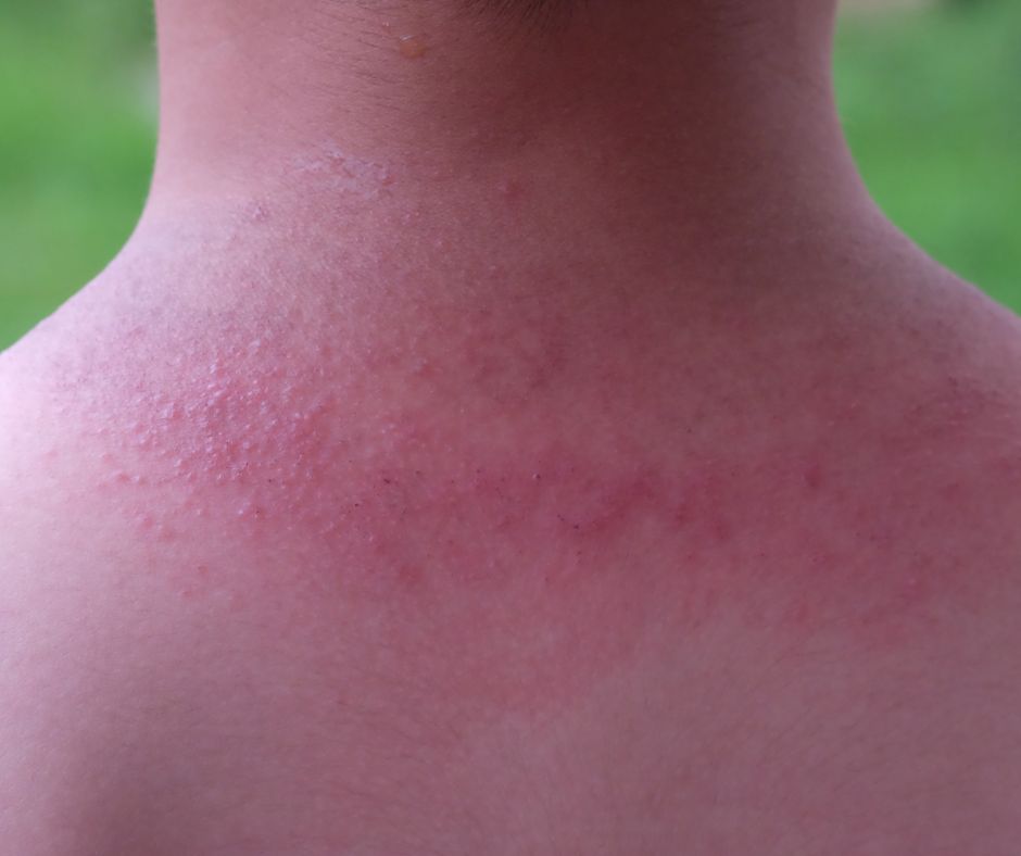 Potni&ccaron;ka &ndash; 4 tipy na lie&ccaron;bu a prevenciu