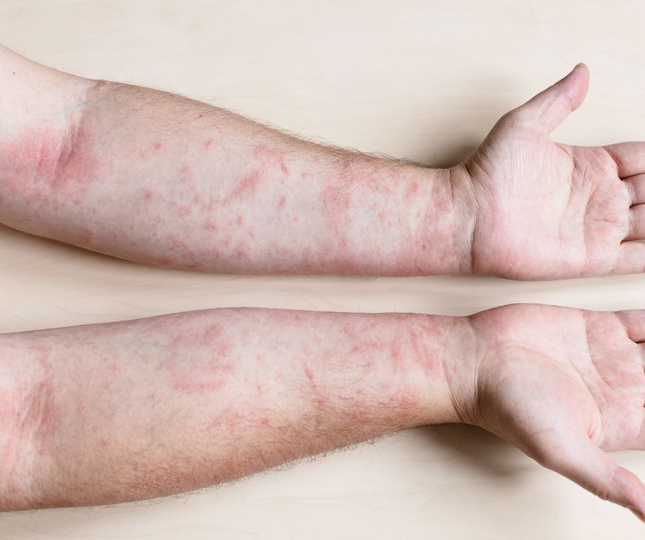 Presna diagnoza a hodnotenie rozsahu lezie su klucove pre spravne a efektivne liecenie