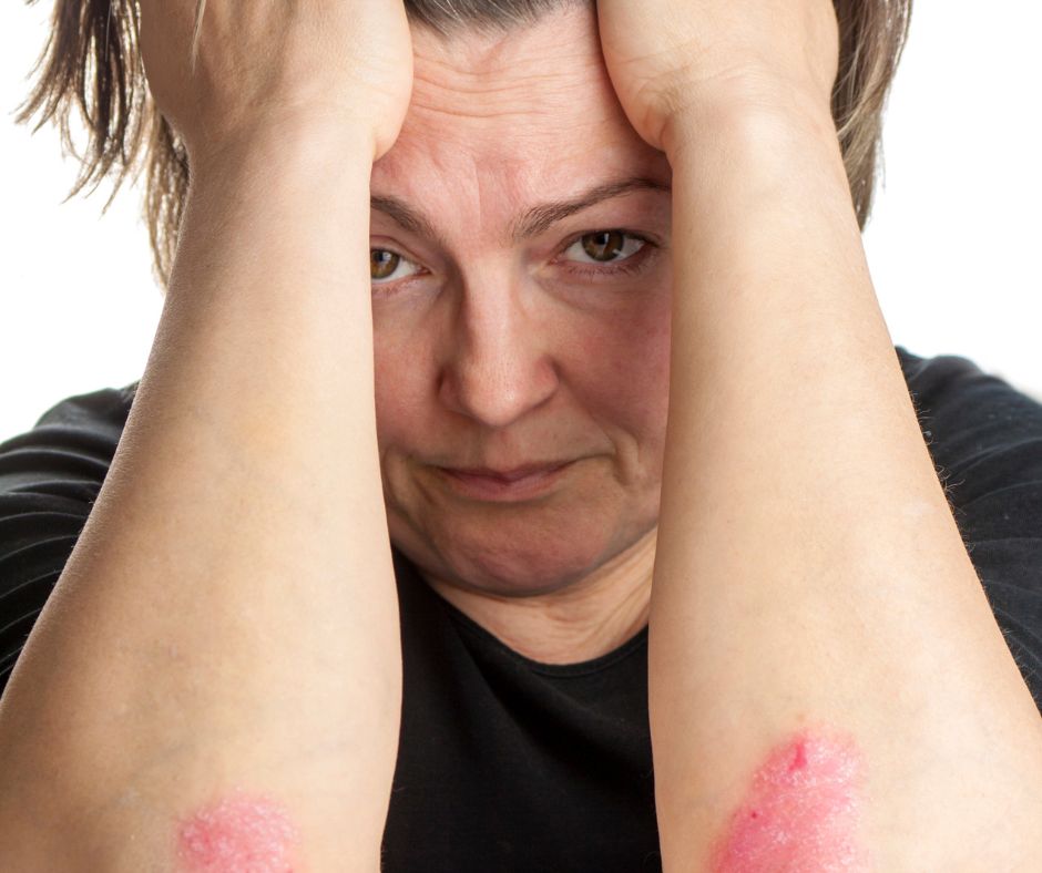 Psoriaza ako chronicke ochorenie moze mat vyznamny vplyv na psychicku pohodu pacientov