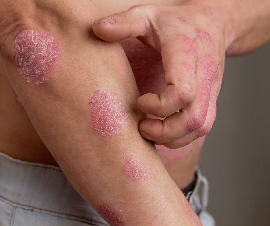 Psori&aacute;za: Pr&iacute;&ccaron;iny, pr&iacute;znaky a prevencia
