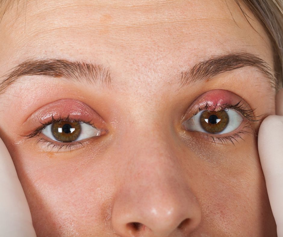 V niektorych pripadoch sa moze jacmen naplnit hnisom a vytvorit zltu alebo bielu skvrnu na vrchole opuchu