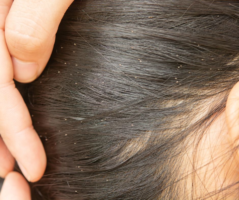 Vsi su male paraziticke hmyzy ktore sa zivia na ludskom tele