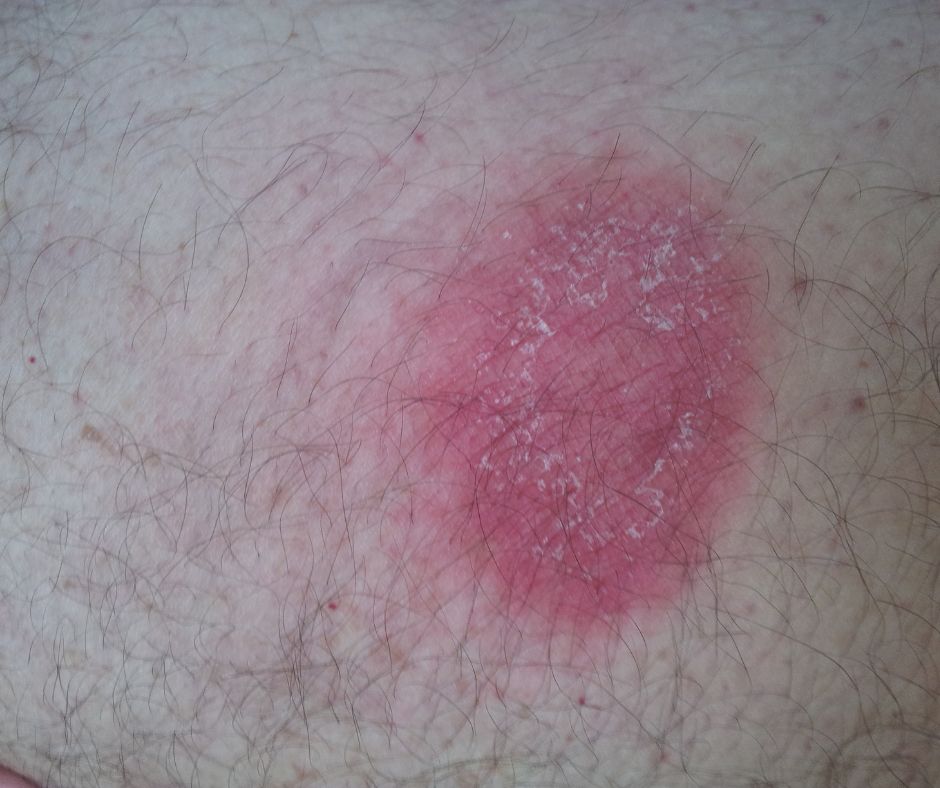 Zaciatocne stadium sa vyznacuje pritomnostou charakteristickej vyrazky nazyvanej erytem migrans ktora sa moze sirit a zvacsovat