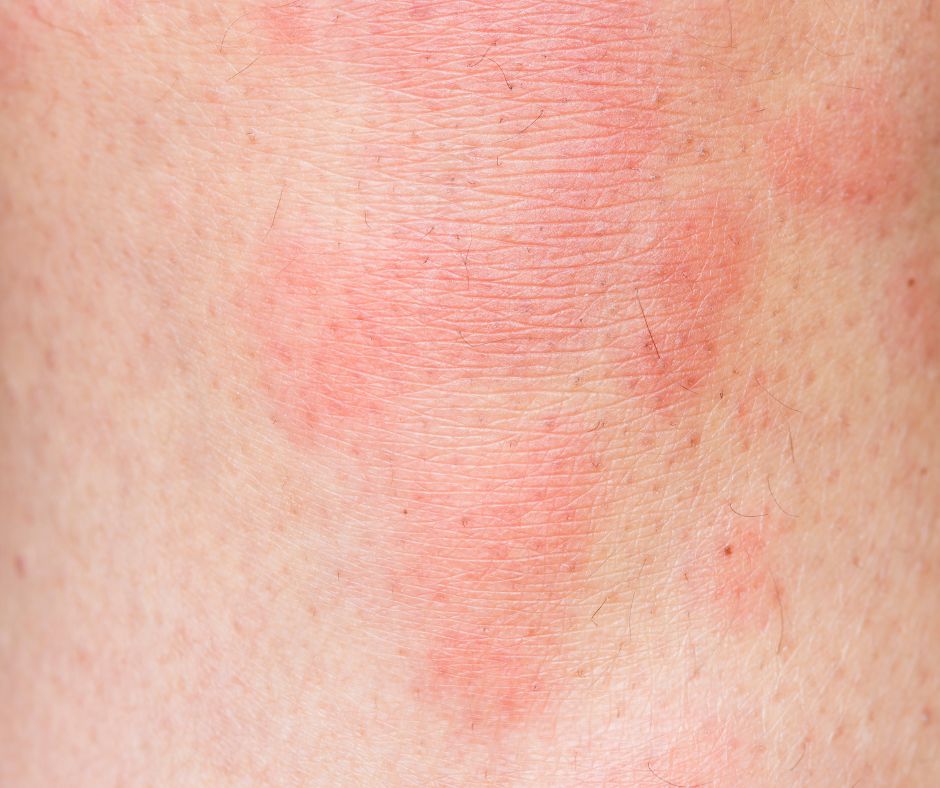 Žihľavka: Príčiny, príznaky a liečba