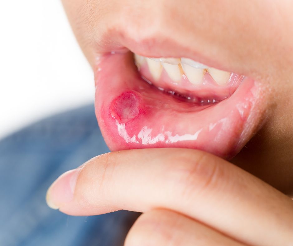 Afty v ustach su male vredy alebo vyrazky ktore sa vyskytuju na sliznici ust