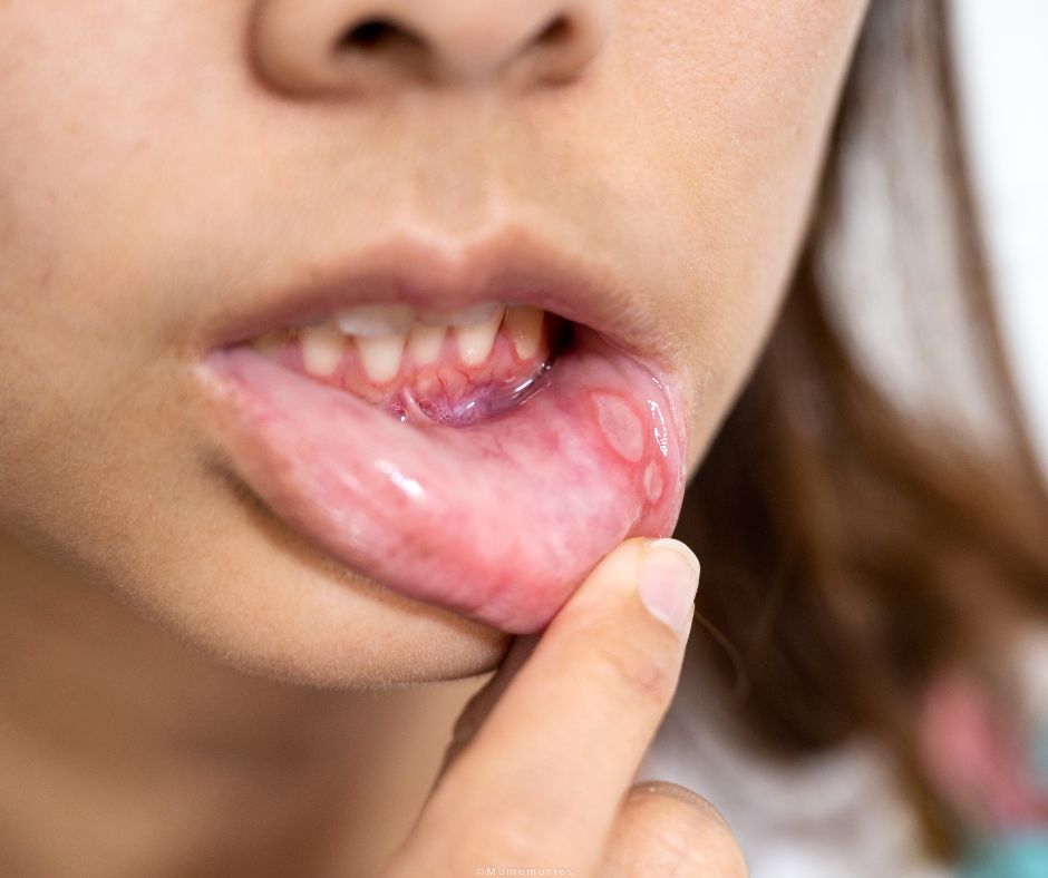 Hoci vacsina aft sa zahoji bez komplikacii v niektorych pripadoch mozu vzniknut problemy