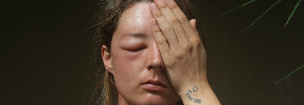 Hoci vacsina ludi po ustipnuti osou zazije len lokalnu bolest opuch a svrbenie niektori mozu mat alergicku reakciu