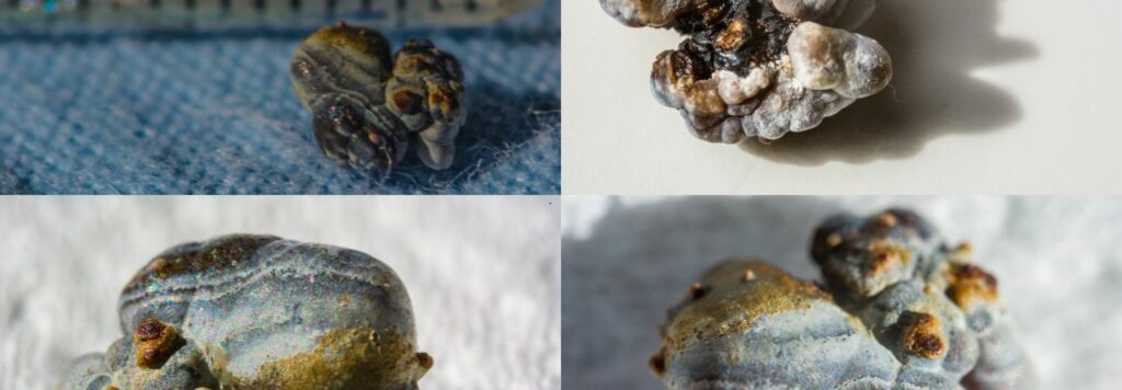 Kamene v oblickach mozu sposobit silnu bolest ked prechadzaju mocovym traktom