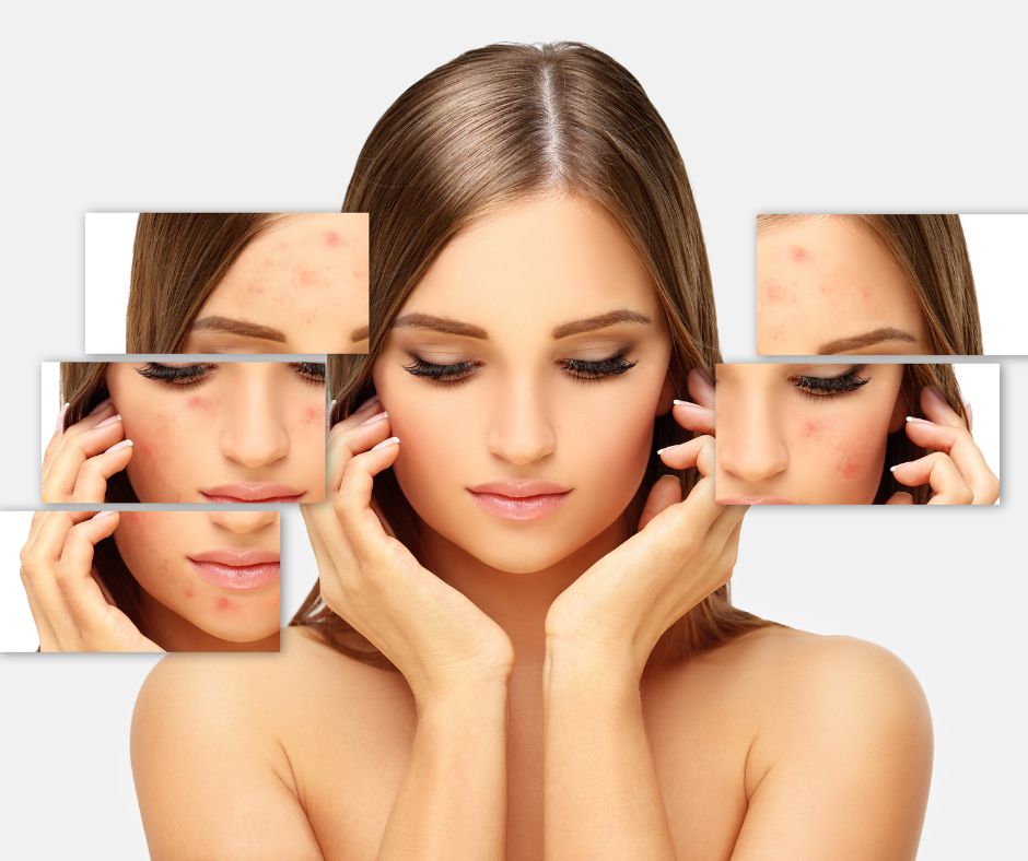 Pre trvalejsie a hlboke akne mozu dermatologovia navrhnut specializovane procedury