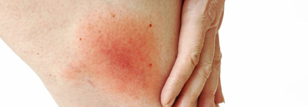 Pr&iacute;znaky boreli&oacute;zy &ndash; 10 naj&ccaron;astej&scaron;&iacute;ch pr&iacute;znakov