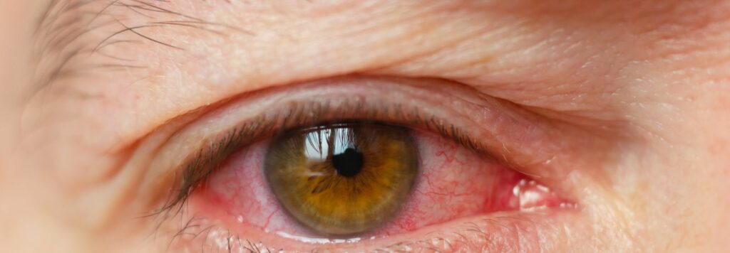 Zapal spojiviek moze mat niekolko pricin pricom najcastejsie su to bakterialne alebo virusove infekcie alebo reakcia na alergeny