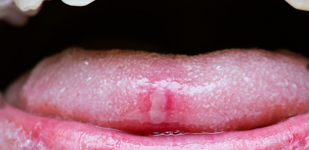 Afty na jazyku – 6 dôležitých informácií