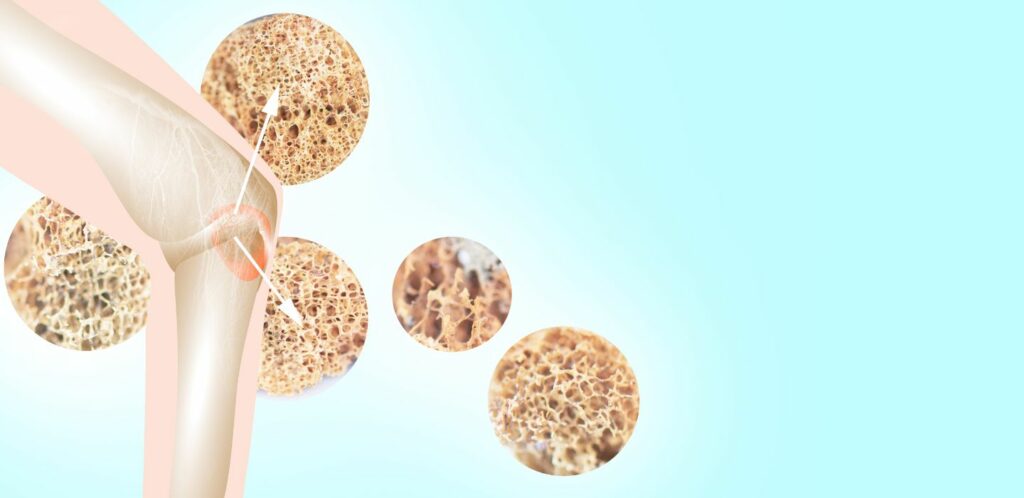 Osteoporoza je casto oznacovana ako 22ticha choroba22 pretoze nema ziadne zjavne symptomy kym nedojde k zlomenine