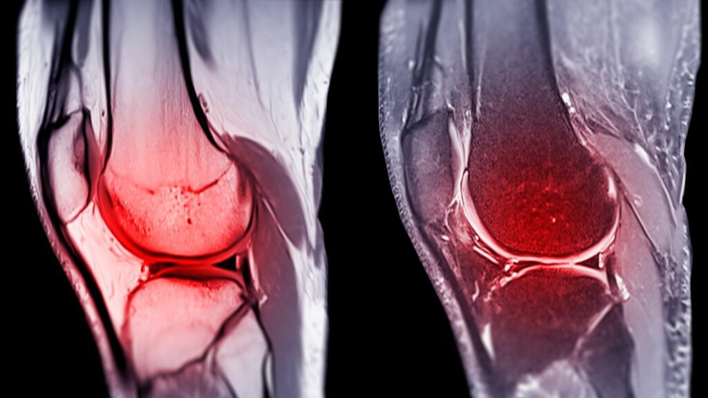 Ako liečiť natiahnuté väzy v kolene – 4 super tipy