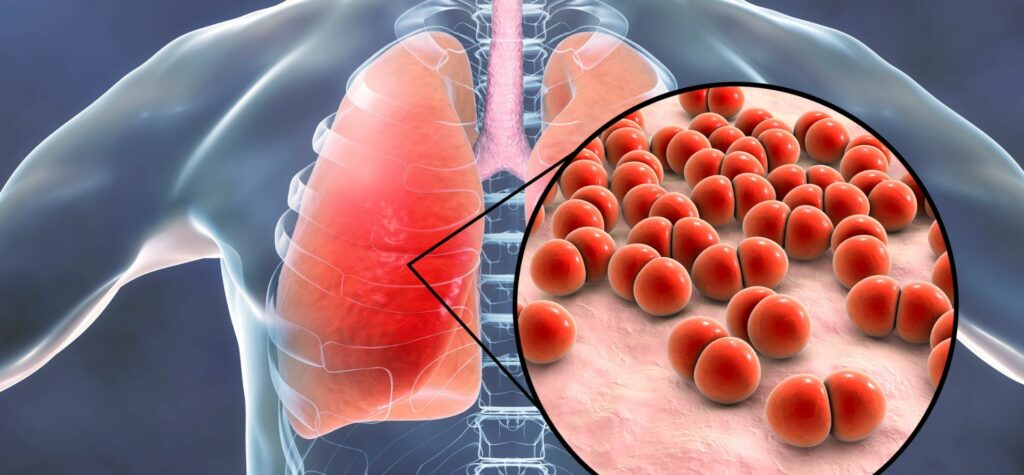 Ako sa prejavuje zápal plúc