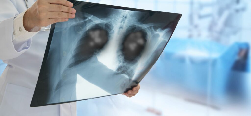 Správna diagnostika zápalu plúc je kľúčová pre určenie príčiny infekcie a výber najvhodnejšej liečby.