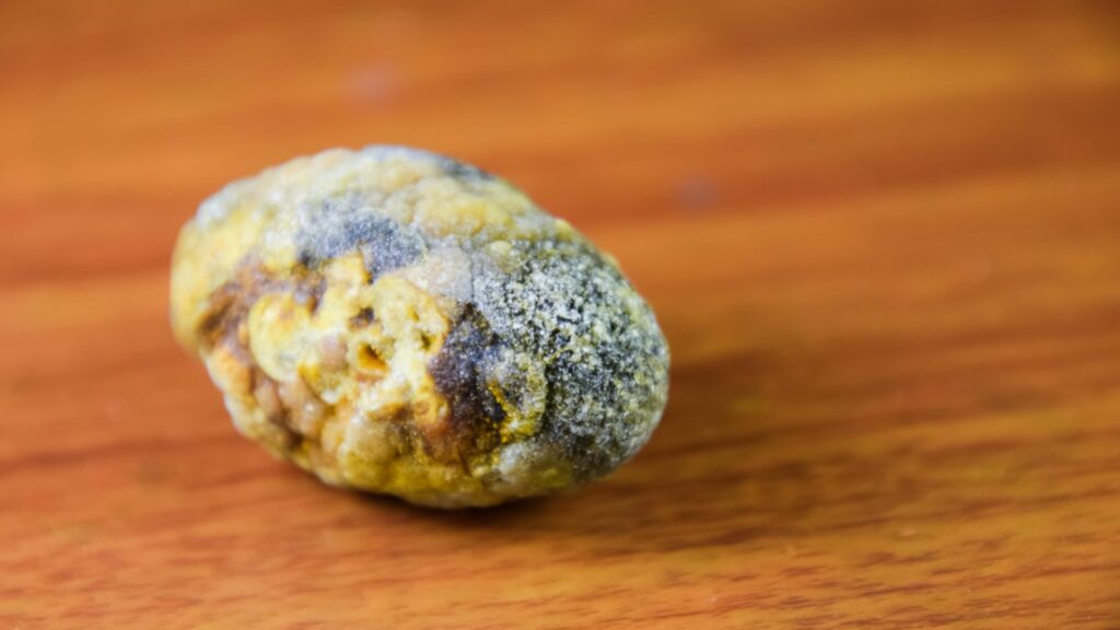 Niektore metody mozu sposobit uvolnenie kamenov ktore mozu zablokovat zlcove cesty a sposobit vazne zdravotne problemy