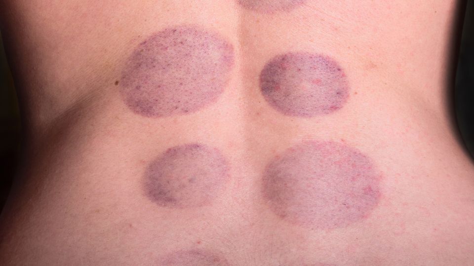 Niektoré štúdie naznačujú, že hirudoterapia môže pomáhať pri regulácii krvného tlaku, hoci tento účinok vyžaduje ďalší výskum.