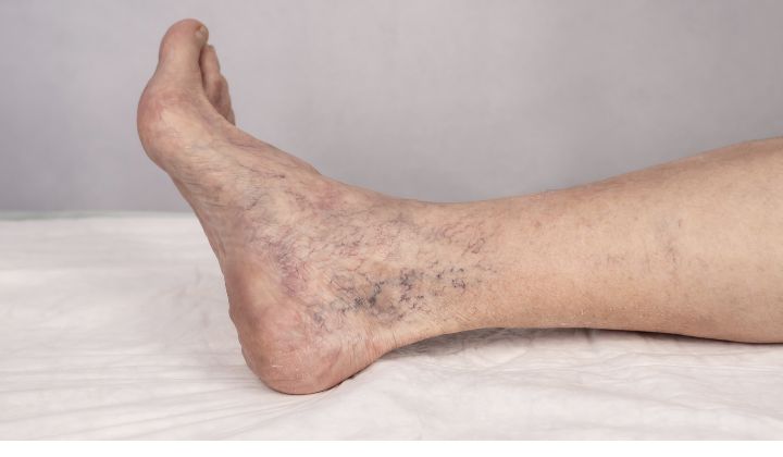 Sklerotizácia je považovaná za efektívnu a osvedčenú metódu liečby kŕčových a pavúčích žíl. 