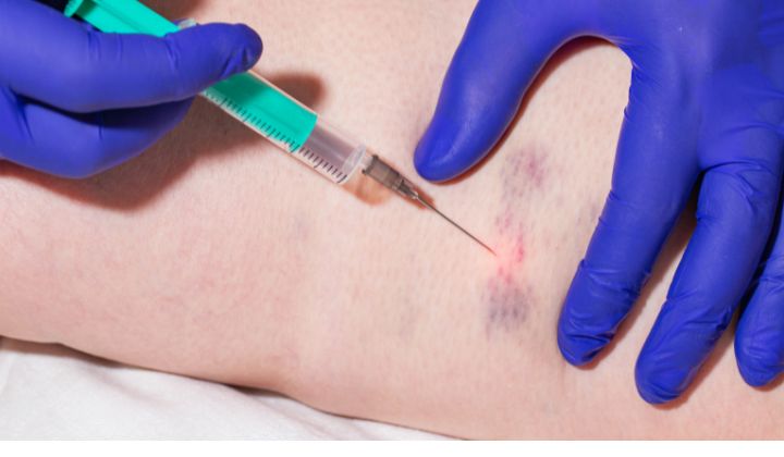 Sklerotizácia je precízny medicínsky zákrok, ktorý sa vykonáva v niekoľkých krokoch. 