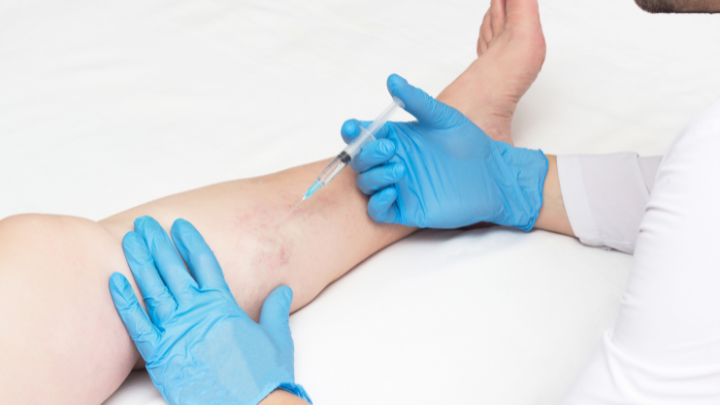 Sklerotizácia – 7 dôležitých informácií